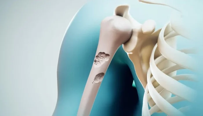 سائنسدانوں نے ہڈیوں کو دوبارہ مضبوط کرنے کا طریقہ ڈھونڈ نکالا