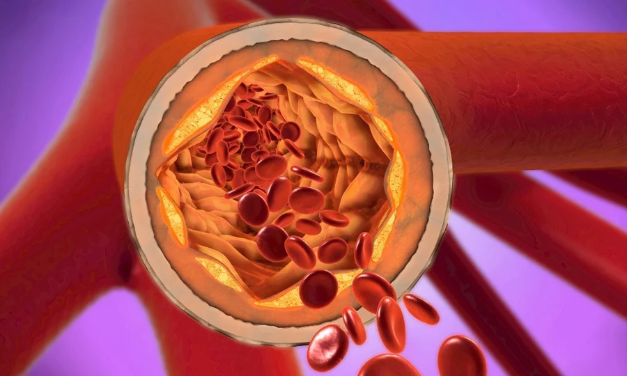 دل کی بیماری کا اصل اشارہ کولیسٹرول نہیں، ایک اور پروٹین زیادہ اہم ثابت