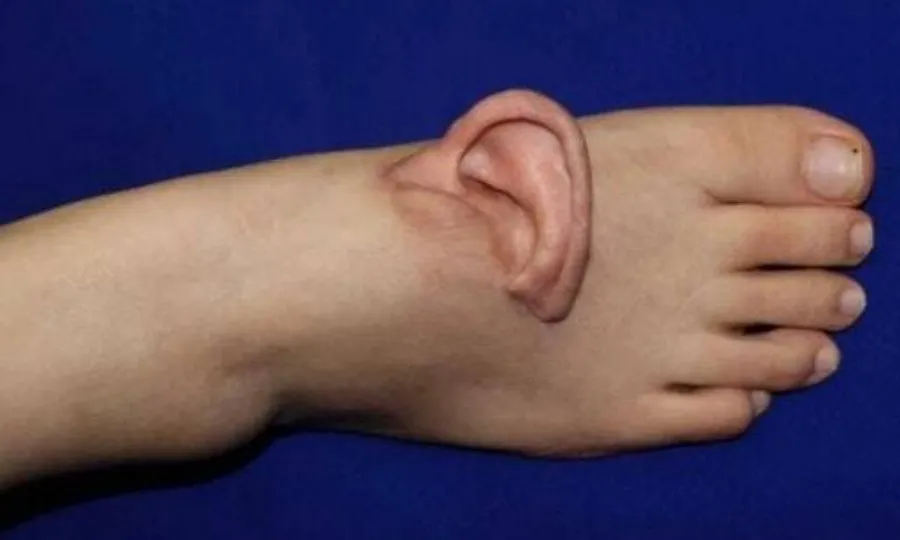 ڈاکٹروں نے کان کو زندہ حالت میں رکھنے کیلئے خاتون کے پیر سے جوڑ دیا