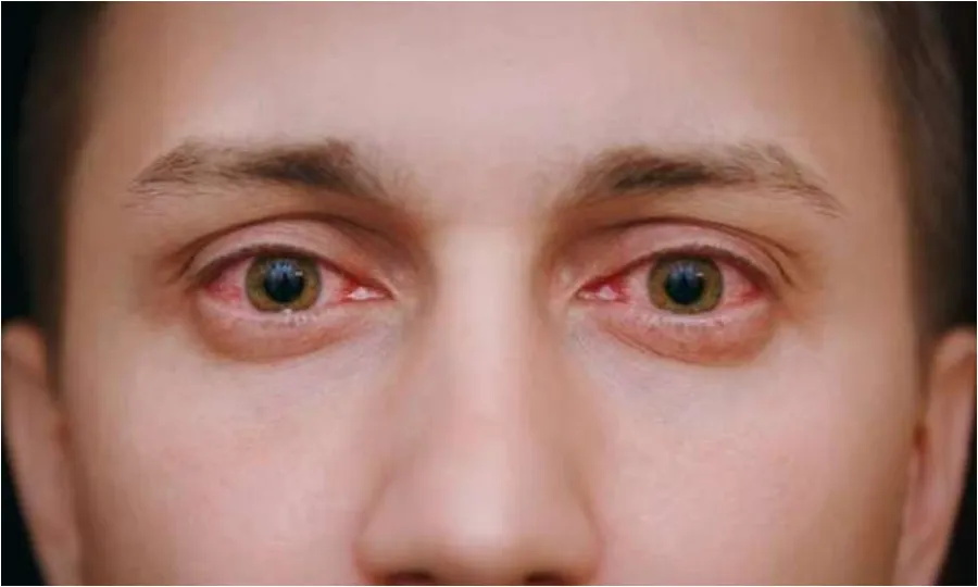 آنکھیں سرخ؟ جانیں حیرت انگیز وجوہات اور احتیاطی تدابیر