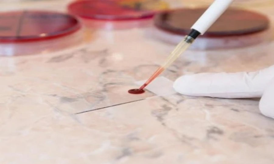 ماہواری کے خون کا ٹیسٹ سروائیکل کینسر کی اسکریننگ کے لیے مؤثر متبادل