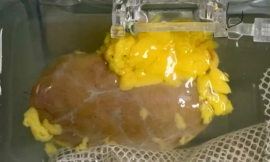 بڑی کامیابی؛ ایسا گردہ تیار جو ہر خون کے گروپ کے لیے قابلِ قبول