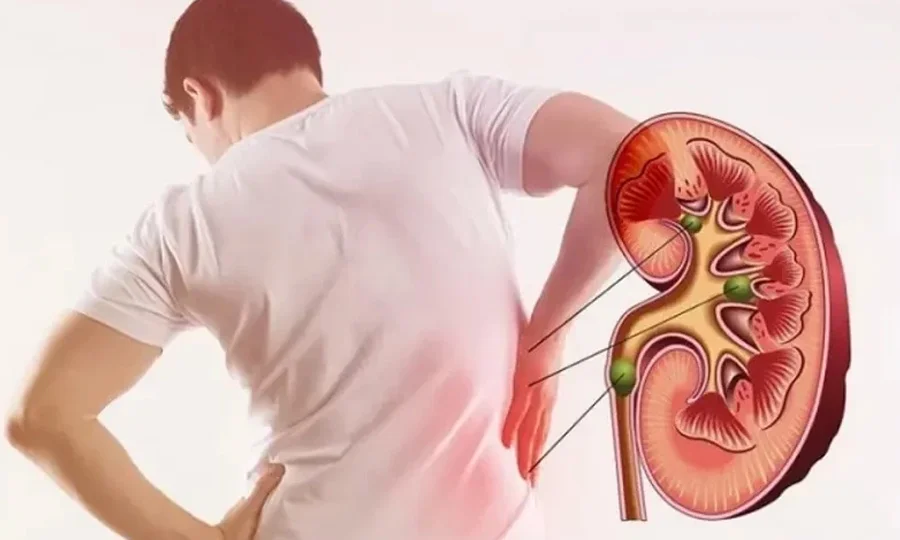 گردے کی پتھری بننے میں بیکٹیریا کا کردار دریافت، نیا علاج ممکن