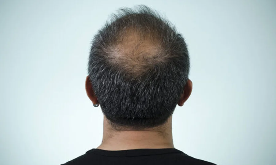 گنج پن کا علاج ممکن ہوگیا؛ بالوں کے مکمل پٹھے تیار، بڑی پیش رفت