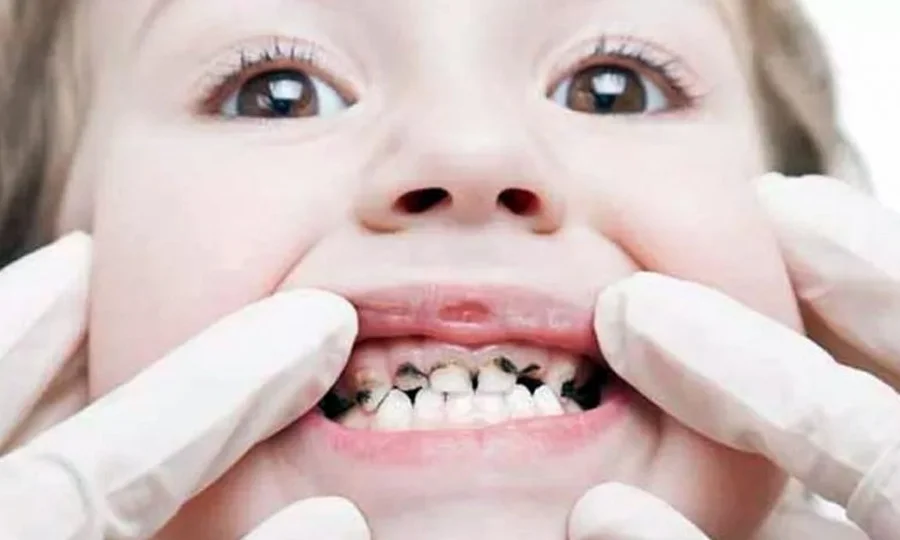 بچوں کے دانتوں کی خرابی روکنے کا نیا اور آسان طریقہ سامنے آگیا