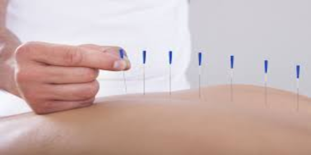 Accupuncture