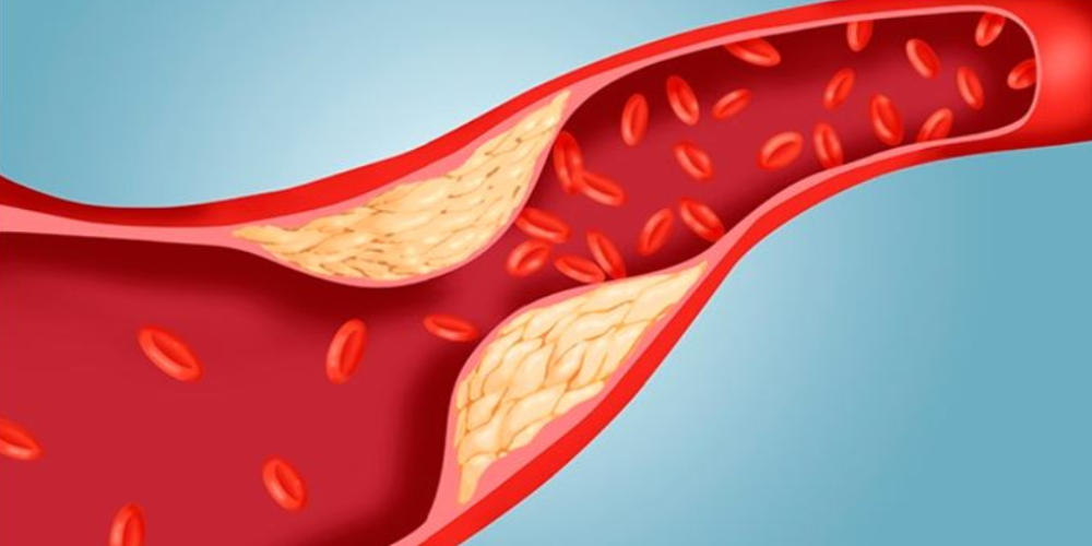 Excessive blood fat causes organ damage