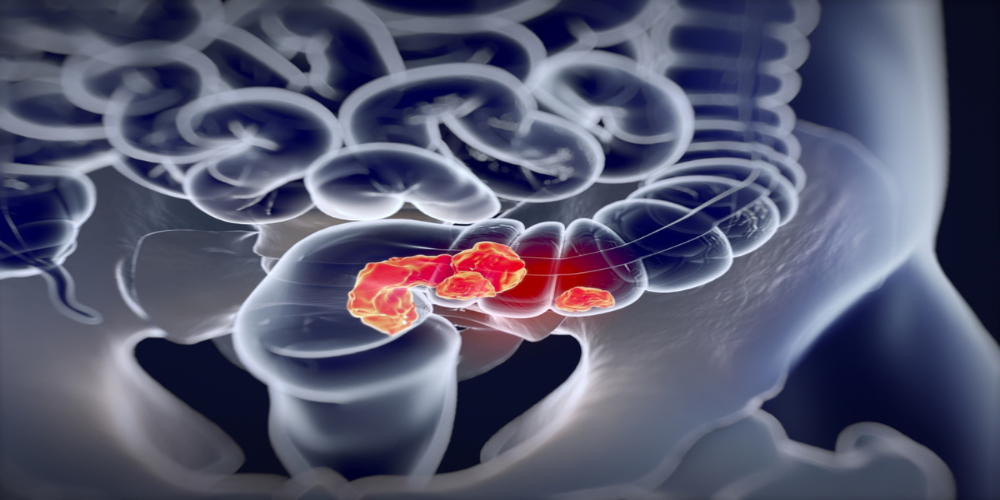 What reduces the risk of Colorectal Cancer?
