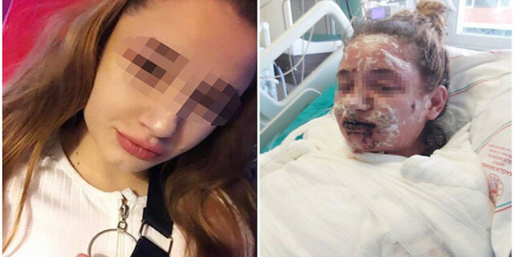 Turkish Girl blinded, burnt alive