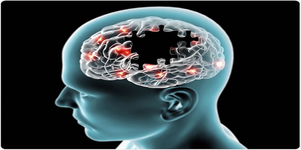 alzheimer'sdisease