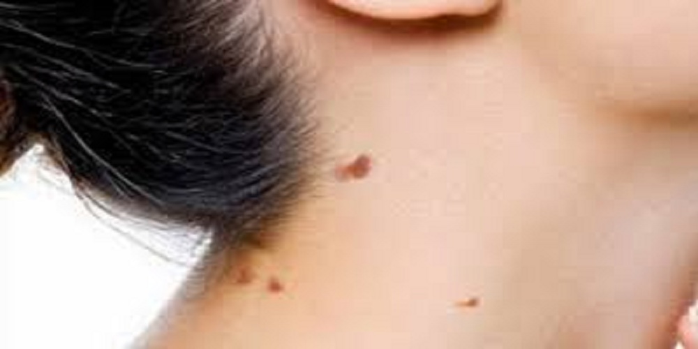 Natural remedies to remove skin tags
