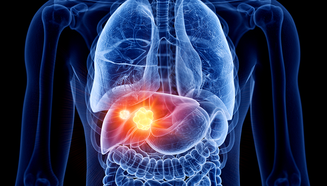 Liver Cancer