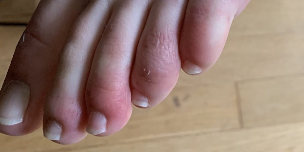 COVID Toes: Latest possible sign of coronavirus