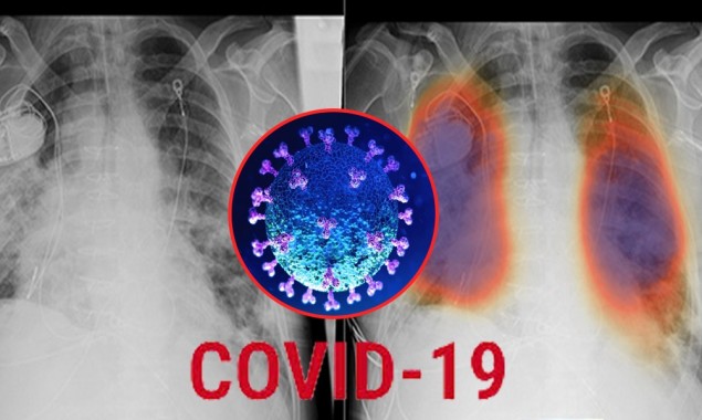 With an Artificial Intelligence Model COVID-19 can be detected in seconds