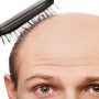 Baldness presents men extra exposed to critical COVID-19 indications