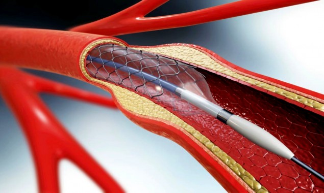Heart stents