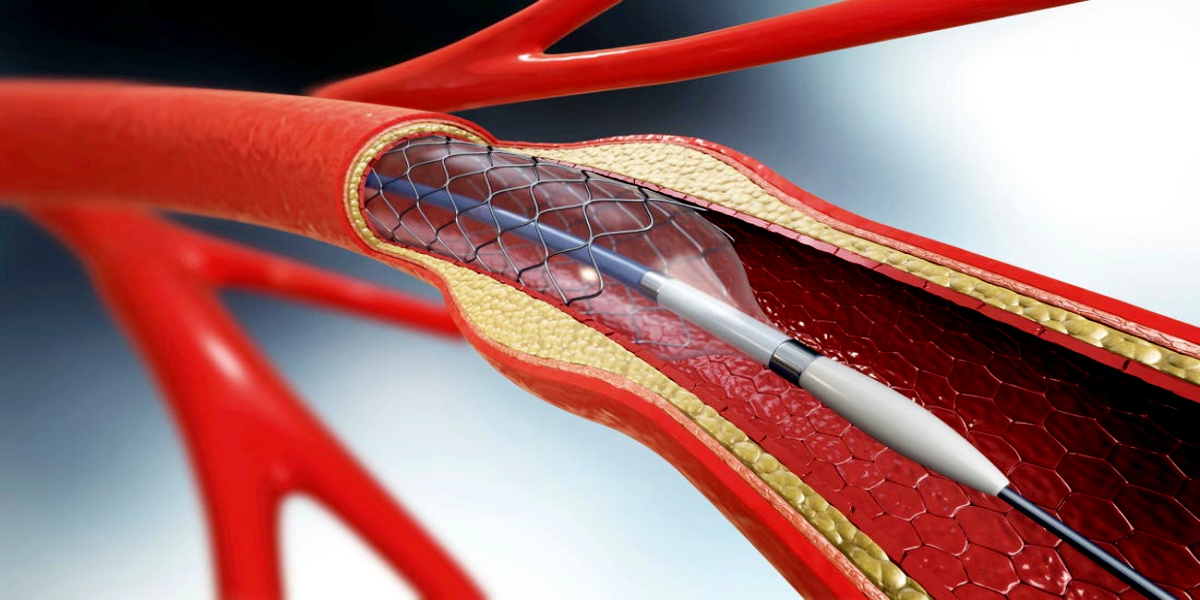 Heart stents