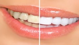 Home Remedies For Teeth Whitening