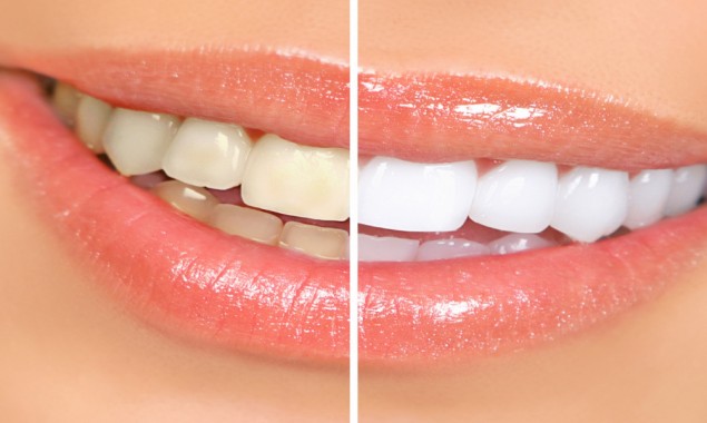 Home Remedies To Have Pearly White Teeth