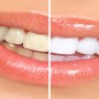 Home Remedies To Have Pearly White Teeth