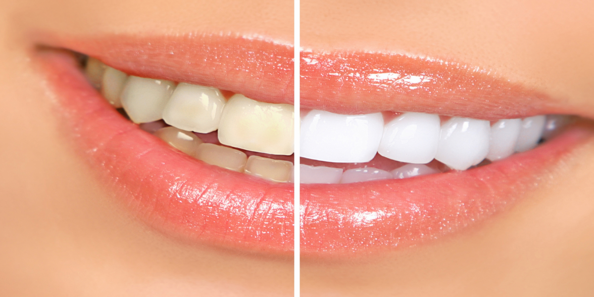 Home Remedies For Teeth Whitening