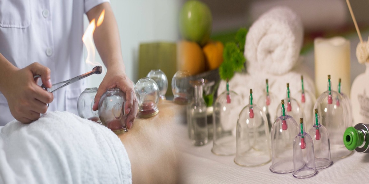 Cupping - Hajama health benefits