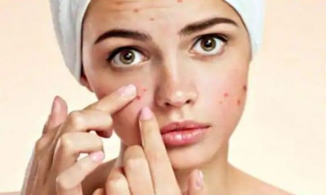 Acne home remedies