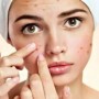 Acne: Treat your skin with these home remedies to kill bacteria