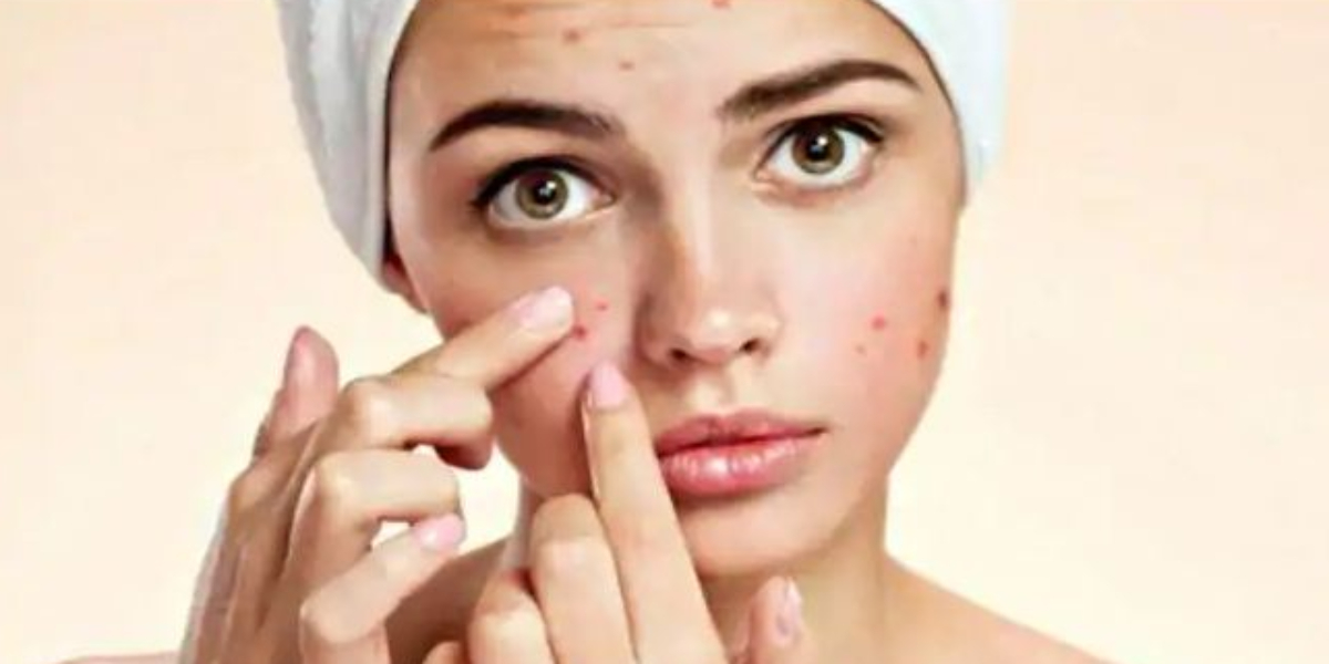 Acne home remedies