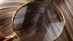 Dandruff causes and treatment