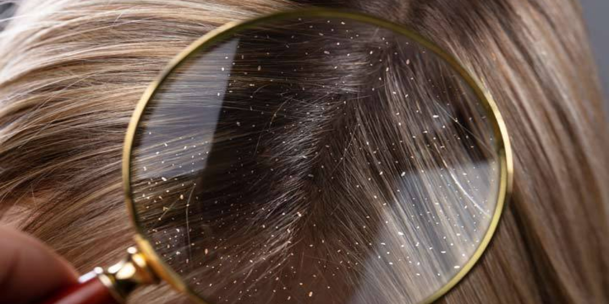 Dandruff causes and treatment
