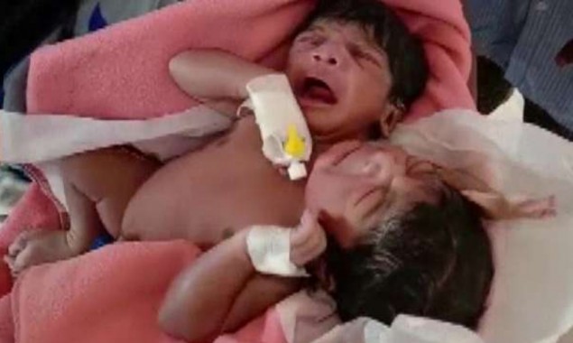 Woman Gives Birth To Conjoined Twins With Three Arms