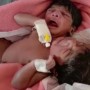 Woman Gives Birth To Conjoined Twins With Three Arms