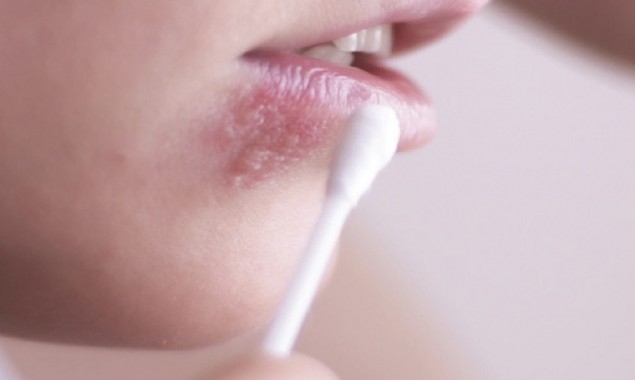 What exactly is Herpes, and what causes it? Here’s all you need to know