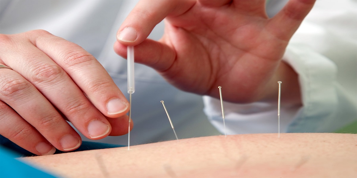 Acupuncture Is Effective for COVID Stress Relief