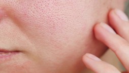5 Simple and Effective Home Remedies for Open Pores