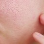 5 Simple and Effective Home Remedies for Open Pores