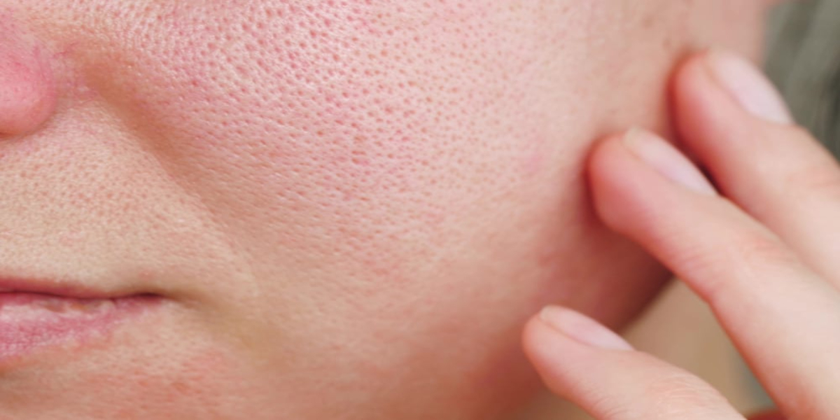 5 Simple and Effective Home Remedies for Open Pores
