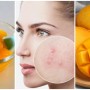 Use This Mango Pulp Mask To Get Clear Pimple Free Skin