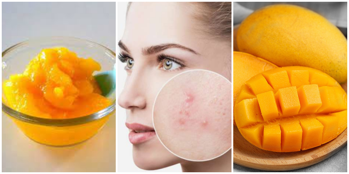 Use This Mango Pulp Mask To Get Clear Pimple Free Skin
