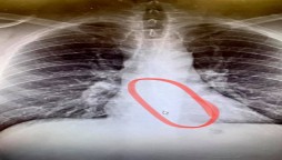 Doctors find the Airpod inside the chest of man’s body