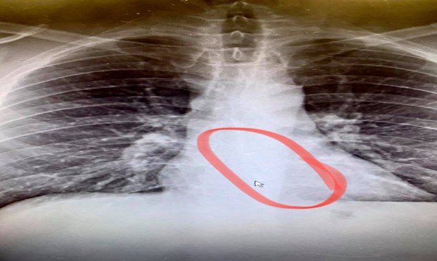 Doctors find the Airpod inside the chest of man’s body