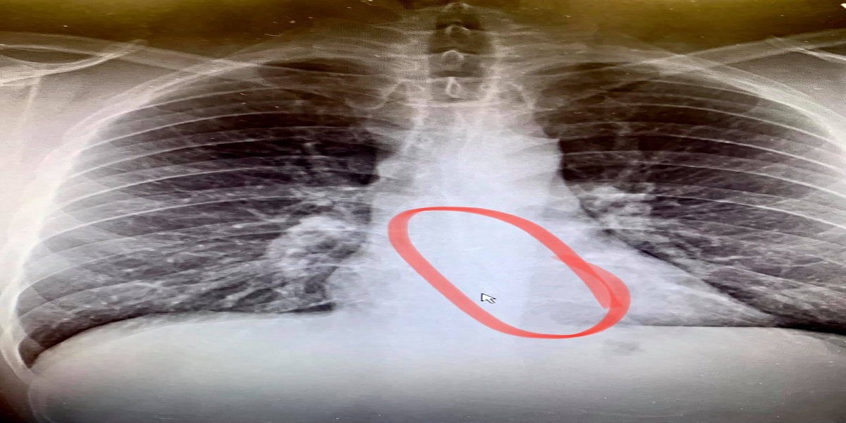 Doctors find the Airpod inside the chest of man’s body