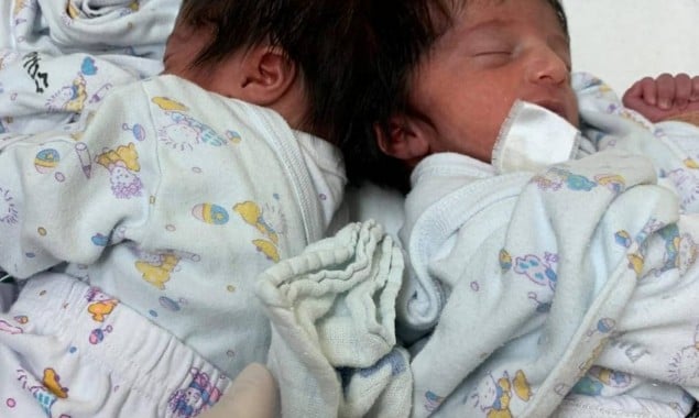 Israeli hospital separates head-connected baby twins in rare operation