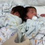 Israeli hospital separates head-connected baby twins in rare operation