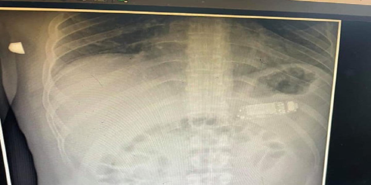 Kosovo: Man swallows the entire phone and needs doctor to remove it