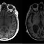 Alzheimer’s can now be detected with just one MRI scan