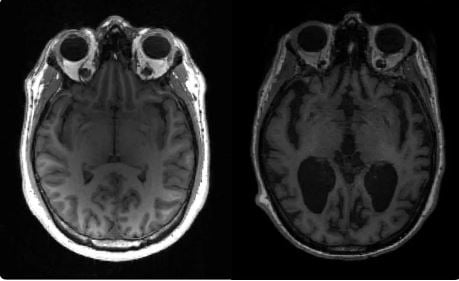 Alzheimer’s can now be detected with just one MRI scan