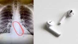 A young man swallowed the AirPods down his throat while sleeping