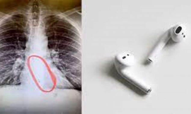 A young man swallowed the AirPods down his throat while sleeping